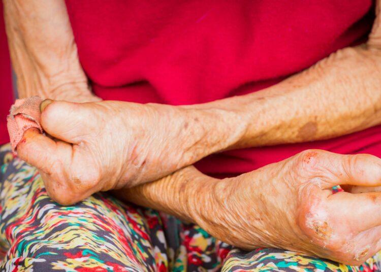 Lepra, una enfermedad que llegó a Colombia en el siglo XIX y que hoy es desatendida