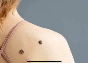 Es una realidad: Crearon vacunas contra cáncer de piel y cáncer de intestino, con resultados exitosos