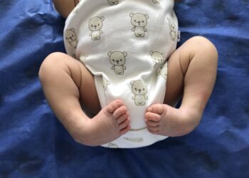 El pie equinovaro en recién nacidos tiene tratamiento eficaz en Colombia